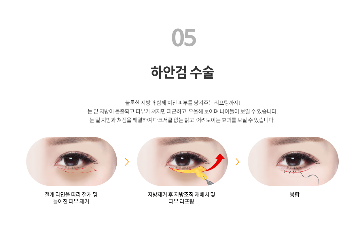 하안검