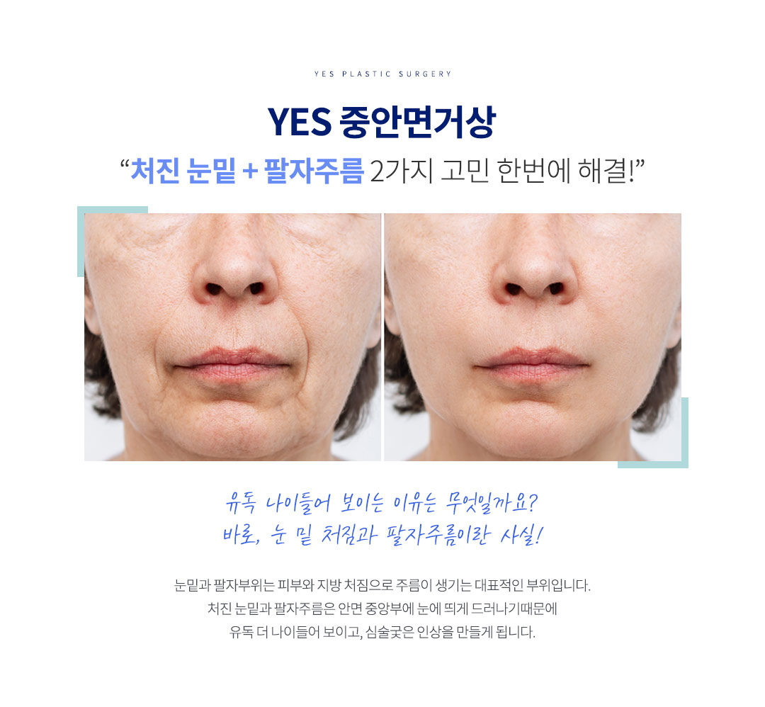 중안면거상