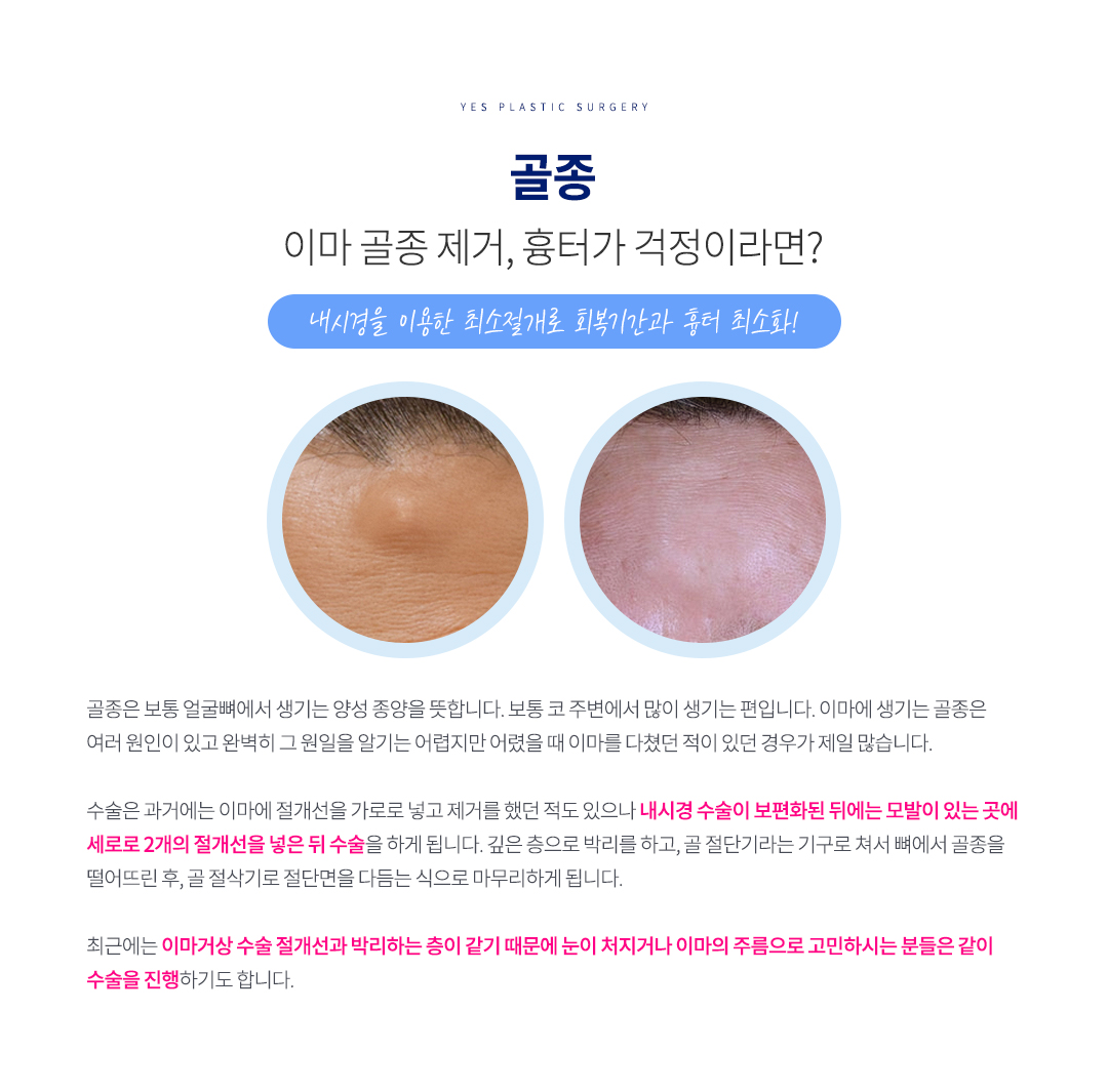 골종