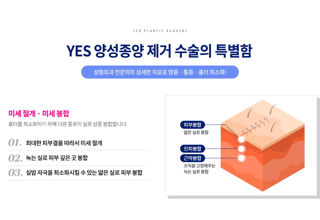 예스 양성종양 수술 특별함